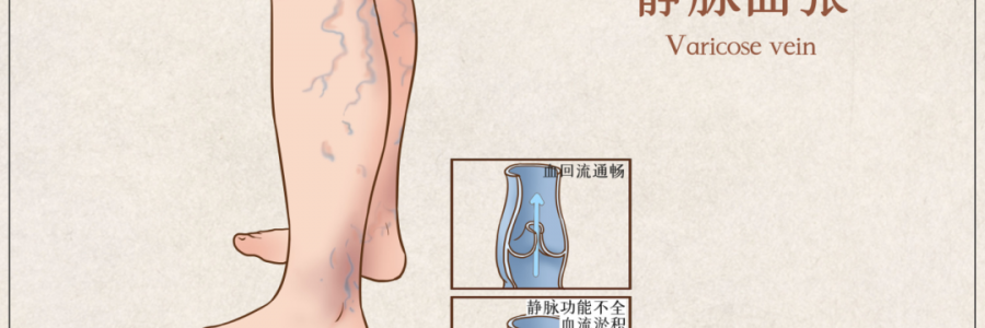 告別“蚯蚓腿”，靜脈曲張怎么調(diào)？