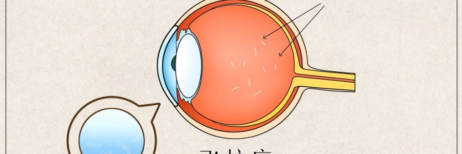 “蚊子”在眼里飛？這類人要注意了！