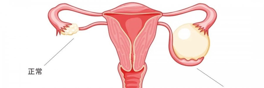 太神奇了，艾灸調(diào)好了她的卵巢囊腫！
